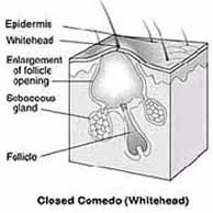 Pimples. Whitehead